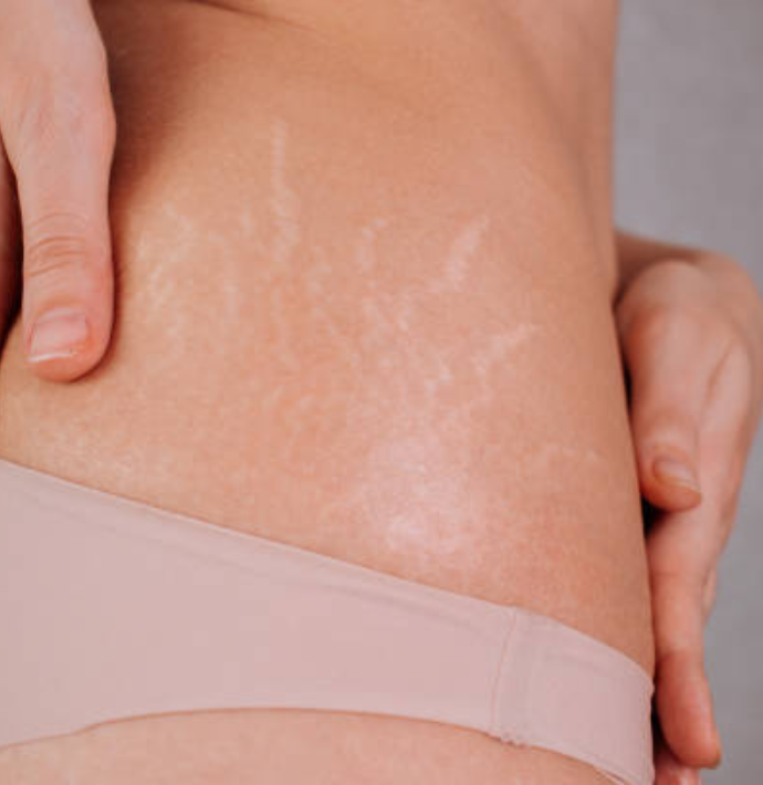 Stretch Mark Treatment